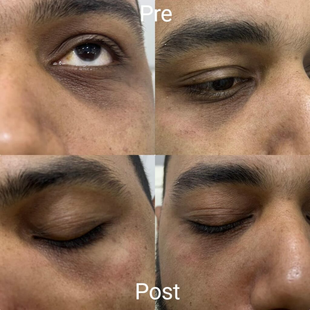 Noticeable improvement in one session for treating dark circles under the eyes
